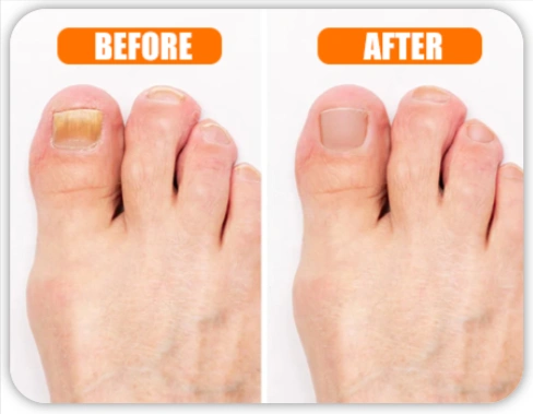 Welnax BioClear Toenail Fungus Device Before & After